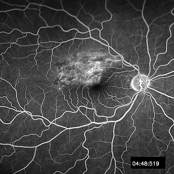 branch-retinal-vein-occlusion-bw.jpg