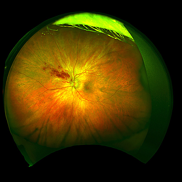 branch-retinal-vein-occlusion.jpg