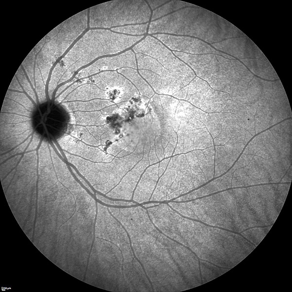 chronic-central-serous-retinopathy.jpg
