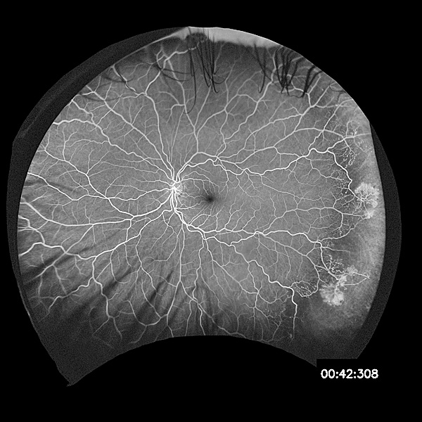 peripheral-retinal-neo-vascularisation.jpg