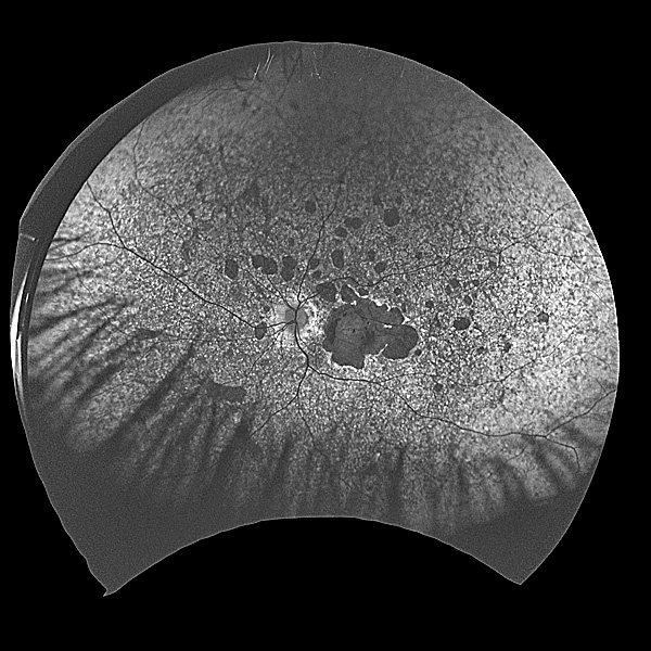 retinal-dystrophy.jpg