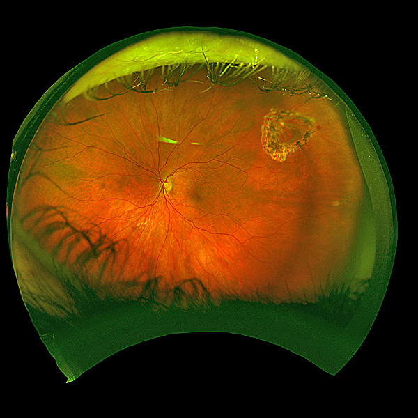 treated-retinal-tear.jpg
